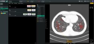 Chungnam National University Hospital Adopts AI Chest Diagnostic Platform AVIEW LCS Plus