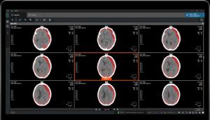 Coreline Soft’s Brain Hemorrhage AI Tops 30,000 Cases as It Joins KSEM 2025