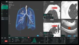 AI-Driven Lung Cancer Screening: Transforming Healthcare Through Innovation and Collaboration