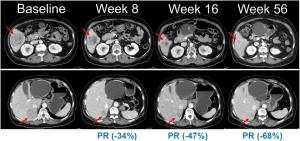 Hanmi Pharmaceutical Starts Phase 2 Trial of Belvarafenib for NRAS-Mutant Melanoma