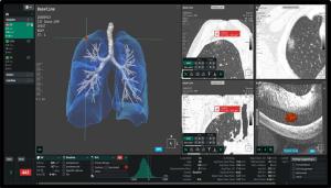 Wonkwang University Hospital Implements AI-Integrated Chest CT Model Using AVIEW LCS