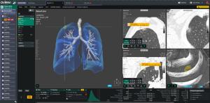 Coreline Soft Joins Swiss Lung Cancer Early Detection Study with KSA Hospital and AstraZeneca