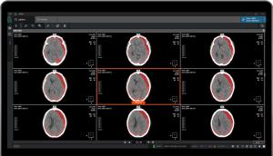 Coreline Soft’s AVIEW NeuroCAD Surpasses 50,000 Uses as Medical AI Adoption Accelerates