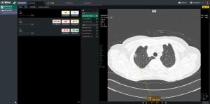 Coreline Soft’s AVIEW Surpasses 500 Studies, Expands Role in Global Medical AI