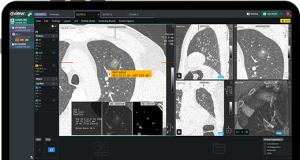 Taiwan Lung Cancer Screening Market Moves Beyond AI Detection Toward Full Screening System Competition